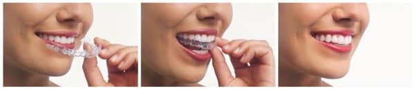 Invisalign Etobicoke